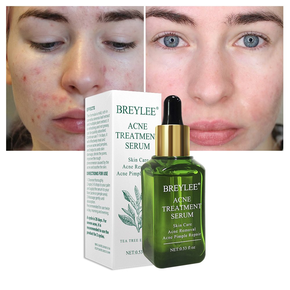 Melia LLC BREYLEE acne treatment serum bottle with dropper next to a before and after comparison of skin texture