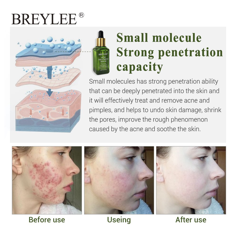 Melia LLC BREYLEE acne treatment serum showing skin penetration diagram and before and after results on a woman